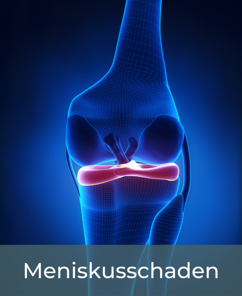 .MENISKUSSCHADEN - SPORTYKNEE